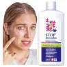 STOP Demodex Tonik do twarzy z MOCZNIKIEM 2% nużyca trądzik wągry 150 ml