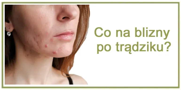 Blizny po trądziku jak się ich pozbyć ?