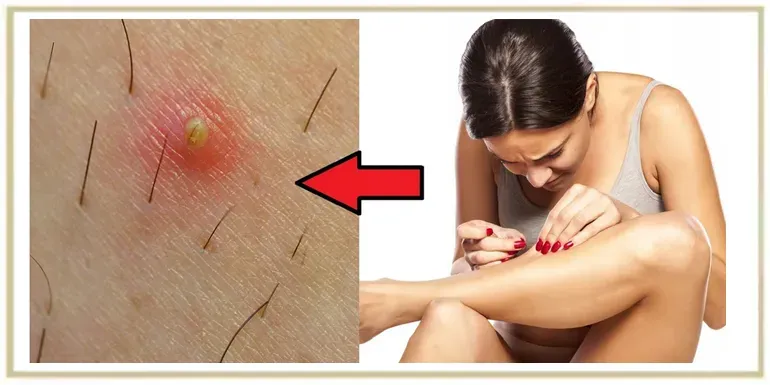 Wrastające włoski po goleniu nóg – jak im skutecznie zapobiegać i jak je usuwać?