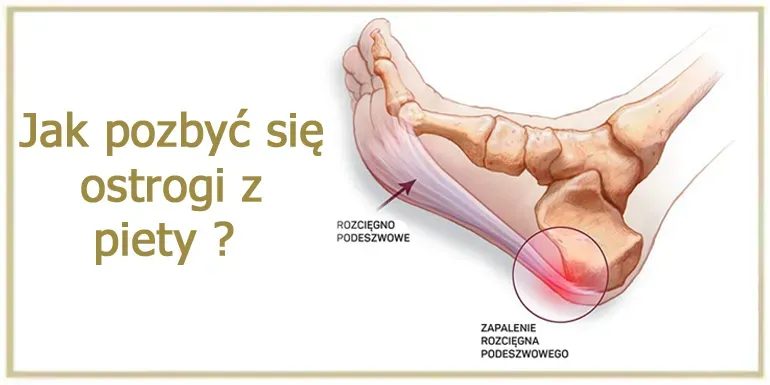 Ostroga piętowa – objawy, leczenie, domowe sposoby i skuteczne ćwiczenia