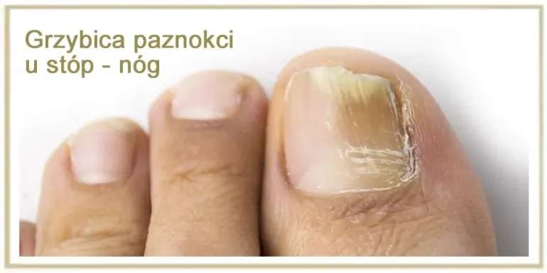 Grzybica paznokci u nóg – jak ją rozpoznać, skutecznie leczyć i zapobiegać nawrotom?