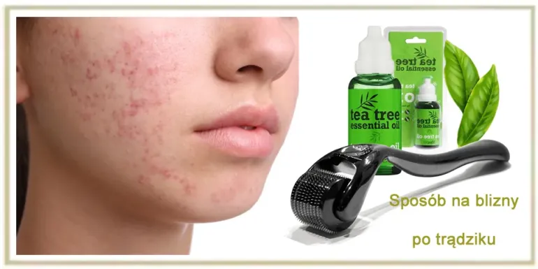 Jak pozbyć się blizn po trądziku domowe sposoby ?