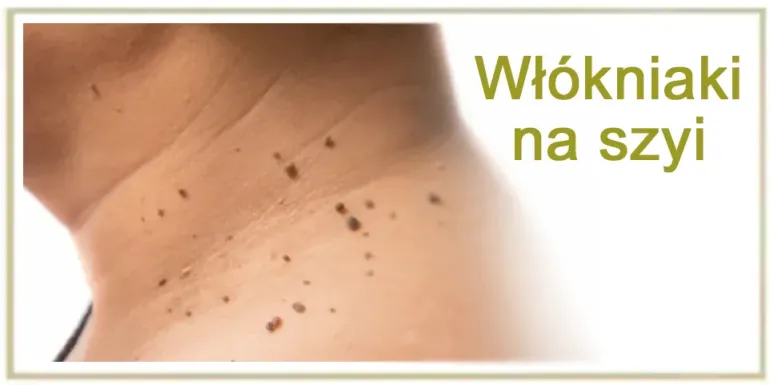 Włókniaki na szyji jak usunąć domowym sposobem