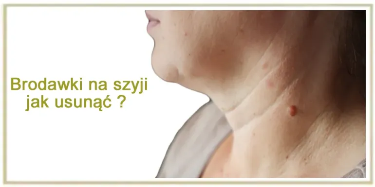 Brodawki na szyi – jak się ich pozbyć? Skuteczne sposoby, dieta i suplementy