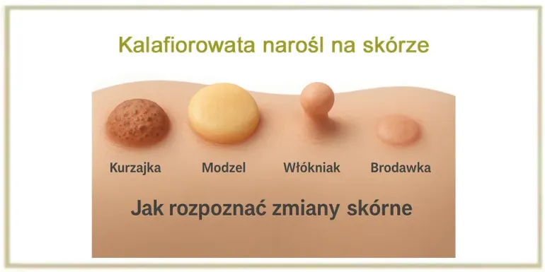Kalafiorowata narośl na skórze - co to jest ? 