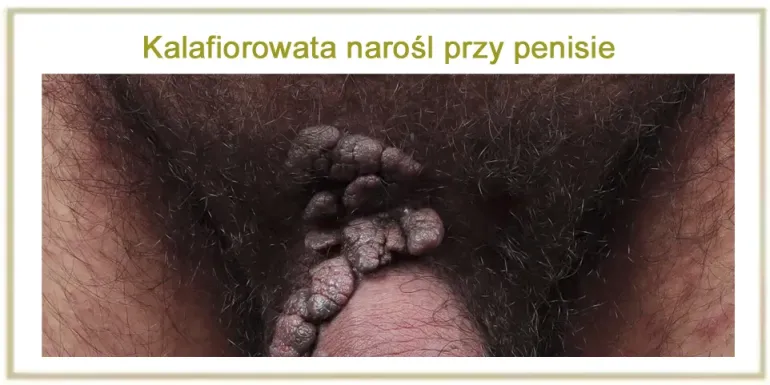 Kalafiorowata narośl przy penisie - brodawki w miejscach intymnych